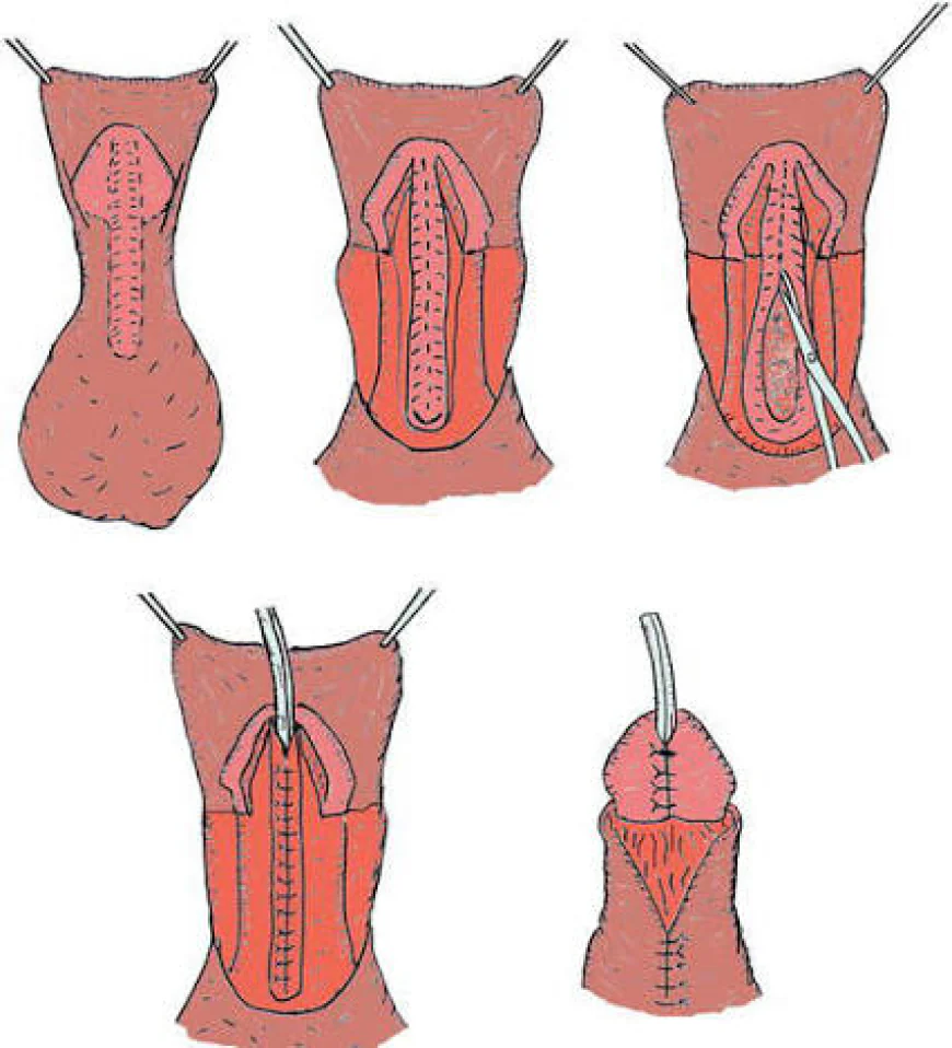Hypospadias Repair Time and Recovery
