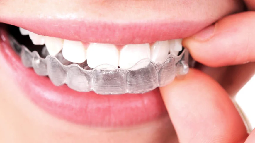 Dental Aligners in Dubai: Treatment Process Explained