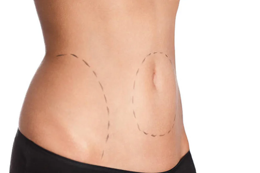 How Painful Is a Body Lift During Healing
