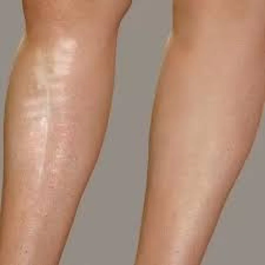 Leg Laser in Dubai | Complete Guide to Long-Lasting Hair Reduction
