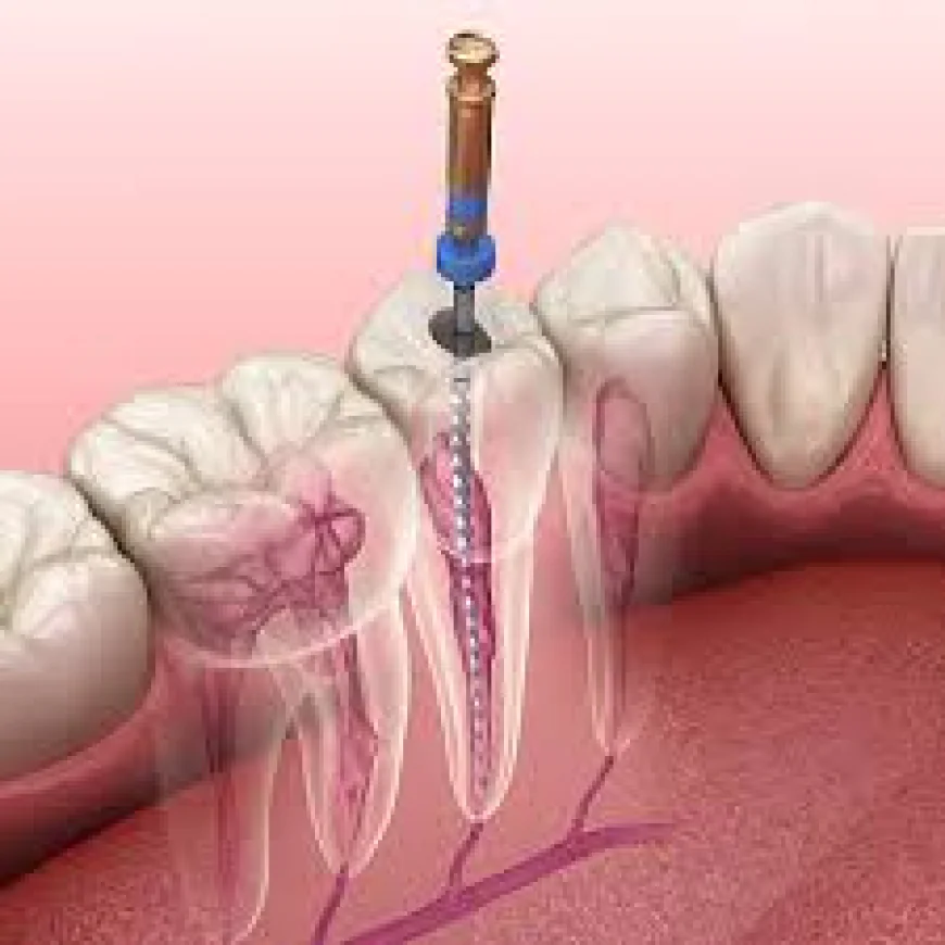 Understanding Root Canal Treatment in Dubai: Symptoms and Solutions