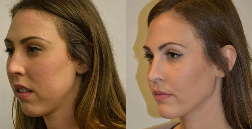 Why Some Jawline Surgery in Islamabad Results Look Better After 6 Months