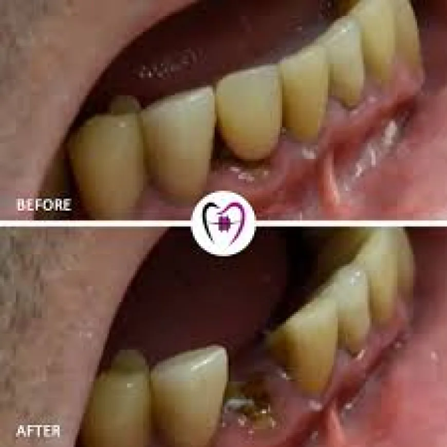 Emergency Tooth Removal in Fitchburg MA | Trusted Dentist at Whalom Dental