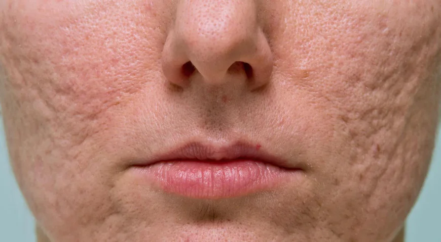 What to Know About Acne Scar Treatments