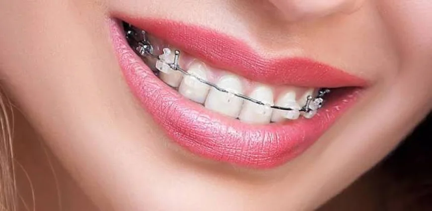 Braces for Adults Benefits and Treatment Options
