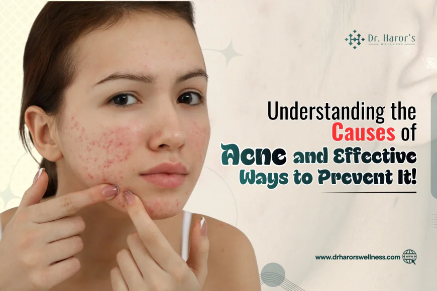 Understanding the Causes of Acne and Effective Ways to Prevent It!
