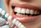 What Sets a Great Dentist in Newport Beach Apart from the Rest?