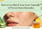 How to Get Rid of Acne Scars Naturally: 12 Proven Home Remedies