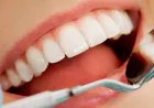 Dental Implants in Dubai vs Dental Bridges