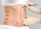 Liposuction in Riyadh for Removing Stubborn Fat Deposits