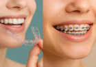 How to Save Money on Invisalign Cost in Gurgaon Without Compromising Quality