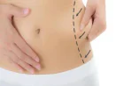 Liposuction Surgery in Dubai: A Complete Guide to Body Contouring and Lasting Confidence