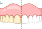 Teeth Whitening Sensitivity: Is It Permanent? | Bryn Mawr