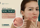 What Causes Acne Scars? Types, Causes & Effective Treatment Options