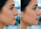 Revision Rhinoplasty Indianapolis: Why Travel to Louisville