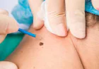 Why Is Skin Tag Removal Considered Beneficial?