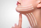 What Is the Average Cost of Neck Lift Surgery?