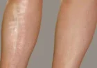 Leg Peel in Dubai for Smooth, Bright, and Healthy-Looking Skin