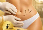 Comprehensive Mons Pubis Lift Treatments | Glamorous Clinic in Dubai