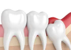 Upper Wisdom Tooth Removal in Bryn Mawr, PA
