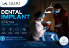 Dental Implant: How the Procedure Works Step by Step