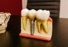 Dental Implants Oxnard CA: Your Complete Guide to a Confident Smile