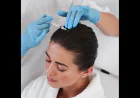Hair Loss in Hyderabad: What You Should Know Before Choosing a Treatment