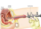 Cystolithotomy Surgery in Gurgaon: Expert Care for Large Bladder Stones
