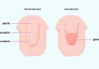 Circumcision Surgery in Gurgaon: Safe and Modern Surgical Care by Dr. Ankit Gupta