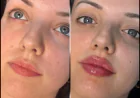 Enhancing Beauty with the Best Aesthetic Clinic in dubai for Fillers
