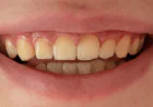 Teeth Whitening in Bryn Mawr | Dillon Family Dentistry