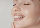Affordable Braces in Houston and Dental Implants in Houston: Transform Your Smile with Antoine Dental Center