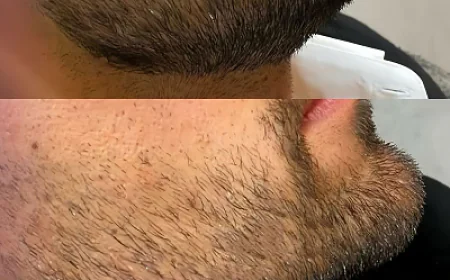 Beard Hair Transplant in Dubai: A Proven Solution