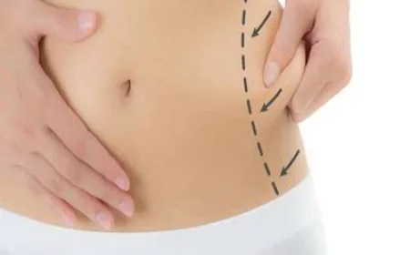 Liposuction Surgery in Dubai: A Complete Guide to Body Contouring and Lasting Confidence