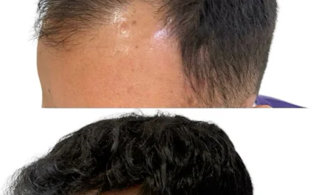 The Science of Scarless Hair Restoration in Dubai