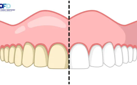 Teeth Whitening Sensitivity: Is It Permanent? | Bryn Mawr