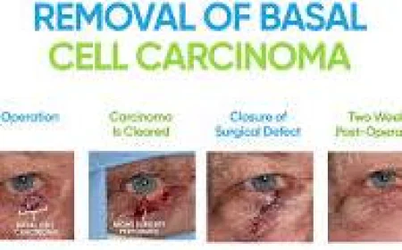 How to Identify and Treat Basal Cell Carcinoma?