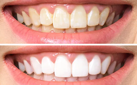Teeth Cleaning Dubai: Why Regular Checkups Matter