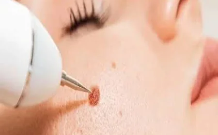 How to Choose the Right Approach to Remove Warts from Face in Dubai for Clearer Skin