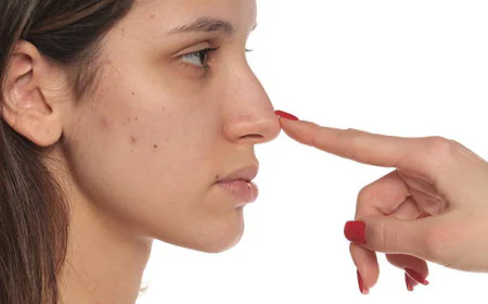 Is Alarplasty Suitable for Every Nose Type?