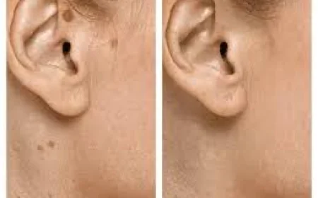 Seborrheic Keratosis Treatment in Dubai | Effective Skin Care Solutions