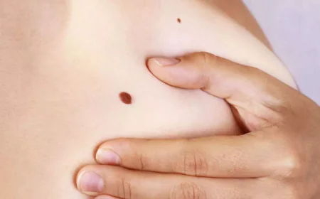 How Skin Tag Removal in Islamabad Has Changed With New Dermatology Methods
