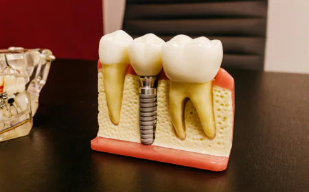 Dental Implants Oxnard CA: Your Complete Guide to a Confident Smile