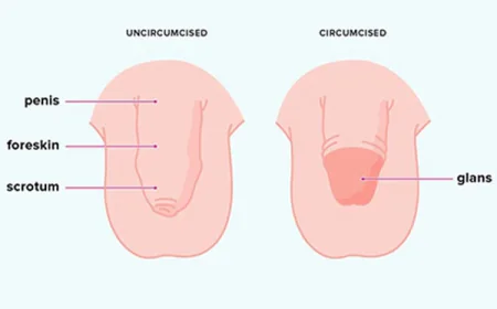 Circumcision Surgery in Gurgaon: Safe and Modern Surgical Care by Dr. Ankit Gupta