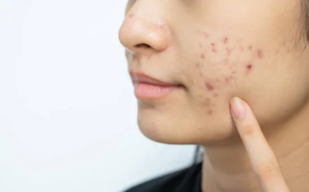 Can Laser Acne Scar Treatment Reduce Pits?