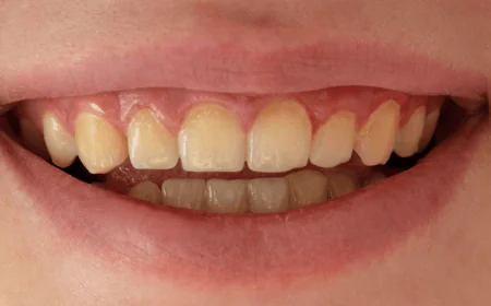 Teeth Whitening in Bryn Mawr | Dillon Family Dentistry