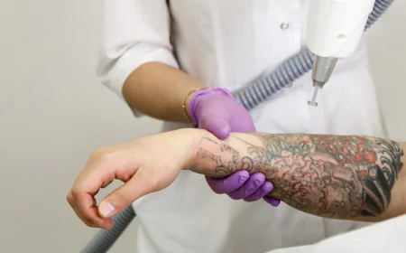 Is Laser Tattoo Removal Considered a Safe Treatment?