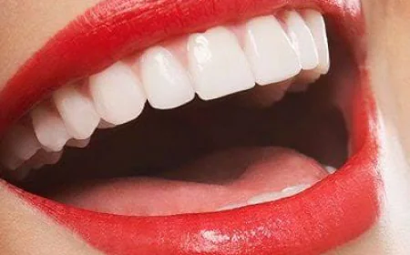 What Is the Process Behind Hollywood Smile Design?