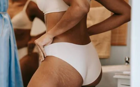 What Factors Affect Stretch Marks Removal?