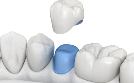 Can Dental Crowns Restore Both Strength and Appearance Naturally?